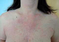 V sign seen in dermatomyositis V-sign seen in dermatomyositis