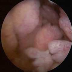 Vili like proliferation arthritis