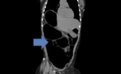 Volvulus on CT scan