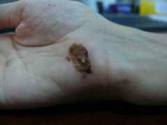 Wound healing day 10