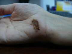 Wound healing day 12