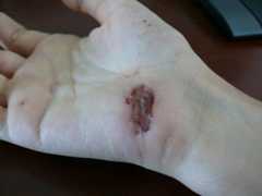 Wound healing day 3
