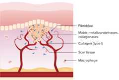 Epithelization