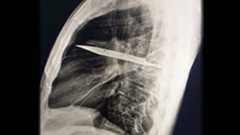an x-ray image of a knife lodged in a man's chest