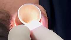 لحظه خارج کردن عنکبوت زنده از گوش زن باردار