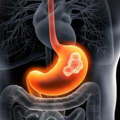 Cancer de l’estomac : les médecins alertent sur ces symptômes souvent confondus avec une simple gastrite. ©&nbsp;peterschreiber.media, iStock