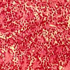 Coupe histologique d'un neuroblastome, vue au microscope optique, montrant les cellules rondes de la tumeur. © Docteur Dominique Plantaz