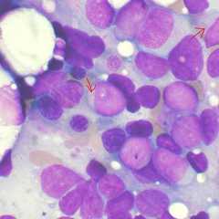 Observation de cellules de la moelle osseuse montrant une leucémie aiguë myéloblastique. © Vashidonsk, Wikipedia, CC by-sa 3.0