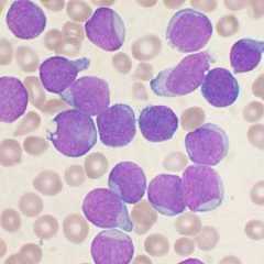 Dans la moelle osseuse d'un patient atteint de LAL, les lymphoblastes (ici précurseurs de lymphocytes&nbsp;B) sont anormalement nombreux. © VashiDonsk, Wikipedia, CC by sa 3.0