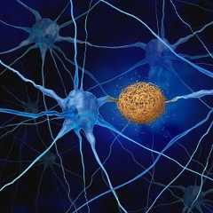 Les plaques amyloïdes, ces amas de protéines qui s’accumulent dans le cerveau, sont responsables de la dégénérescence des neurones et des troubles de la mémoire caractéristiques de la maladie d’Alzheimer. Mais une étude américaine du MUSC Hollings Cancer Center révèle que cette même protéine pourrait renforcer le système immunitaire et aider à lutter contre le cancer. © freshidea, Adobe Stock