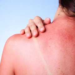 Les remèdes naturels comme l’aloe vera ou le concombre apaisent efficacement les coups de soleil.&nbsp;© jivimages, Adobe Stock