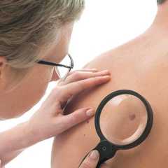 Le dépistage du cancer de la peau passe par le suivi des grains de beauté. © Alexander Raths, Shutterstock