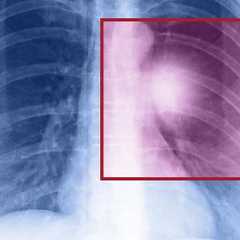 Le cancer du poumon peut être détecté par une radiographie, un scanner thoracique et une biopsie. © muratart, Shutterstock