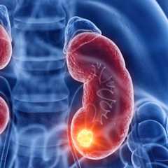 Tumeur se développant dans le parenchyme rénal. © SciePro, Adobe Stock