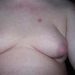 La gynécomastie peut simplement être gênante, mais aussi être le signe d'une maladie plus grave. © FatM1ke, Wikimedia, GFDL 1.2