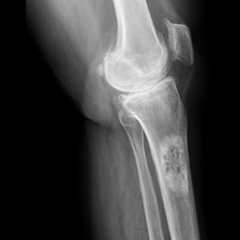 Le cancer de l'os peut être détecté par radiographie. © wonderisland, Shutterstock