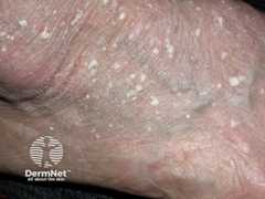 Florid lesions of stucco keratoses on the ankle