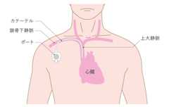 埋め込み型のポートのイメージ図