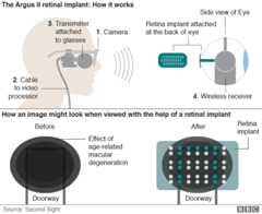 Infographic showing how bionic eye works and what it can see