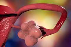 An illustration of polycystic ovary syndrome, which causes the ovaries to enlarge