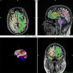 [건강포커스] "근육량 많고 복부지방 적을수록 뇌 노화 속도 느리다"