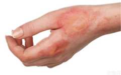 儿子割大腿三分之二皮肤救母，古代有哪些治疗烧伤的偏方？