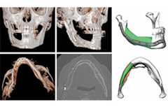 Clinical Outcomes of Scapular versus Fibular Free Flaps in Head and Neck Reconstructions: A Retrospective Study of 120 Patients