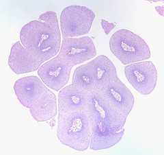 Squamous Papilloma of the Vocal Cord