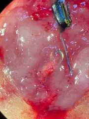 SAVI SCOUT in a lymph node positive for metastatic carcinoma