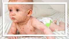 عکس/ شایع‌ترین بثورات ویروسی در نوزادان