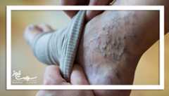 واریس پا: خودمراقبتی و روش‌های خانگی موثر