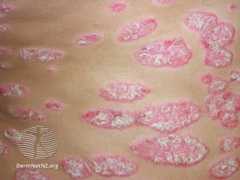 Psoriasisplakk