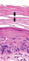 Parakeratose