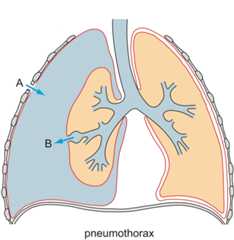Pneumothorax
