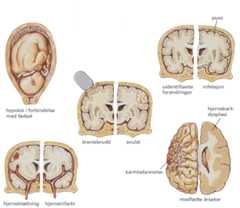 epilepsi