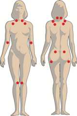 Fibromyalgi.