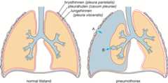 Pneumothorax.