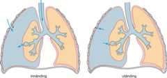 Pneumothorax.