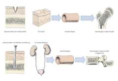 Osteomyelitt.