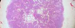 Normal lymfeknute