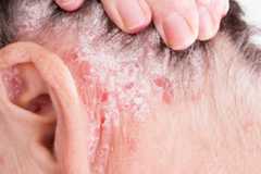 Psoriasis