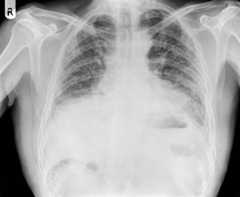 Røntgenbilde av en pasient med lungefibrose, nærmere bestemt idiopatisk pulmonal fibrose.