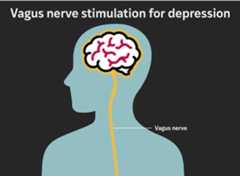 An animation of a small implanted device under the skin in the chest that emits carefully calibrated electrical pulses to the left vagus nerve — a major conduit between the brain and internal organs.