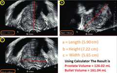 Prostate Volume Calculator