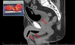 Impotent man's partner accidentally deploys insulation foam inside his urethra during act
