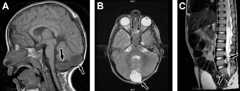 Caudal regression syndrome-a) Brain MRI shows 2 cystic structures at the region of cisterna magna b) cyst is also shown on axial T2-weighted image c) MRI dorsolumbar spine showing abrupt cutoff and bulbar configuration of conus medullaris at the level of L1