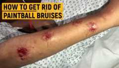 how to treat paintball bruises