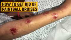 how to treat paintball bruises