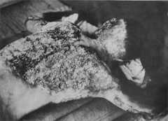 1945年8月、背中全面に原爆による熱傷を受けた犠牲者