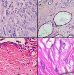 breast_cancer_detection